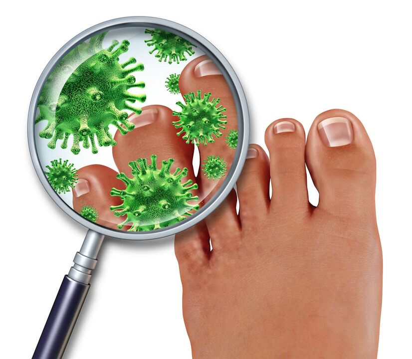 nail gombák a láb kezelése és jelek