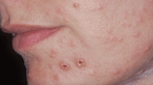 A bőr gombás fertőzése az arcon
