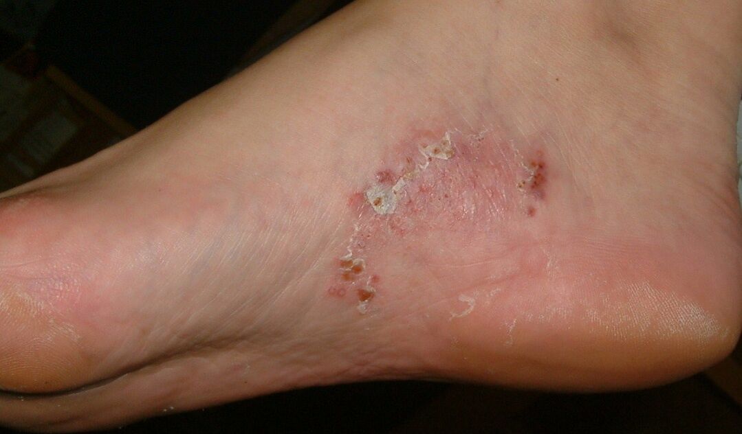A gombás fertőzés megnyilvánulása a lábon